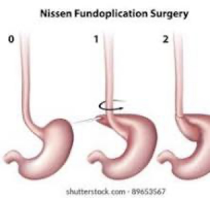 NISSEN FUNDOPLICATION